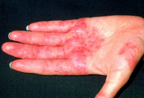 Hand Eczema 