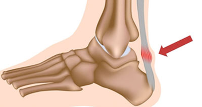 Achilles tendon pain