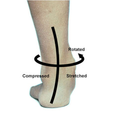 Flat foot causing lower leg rotation