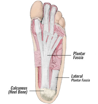 Plantar fasciitis