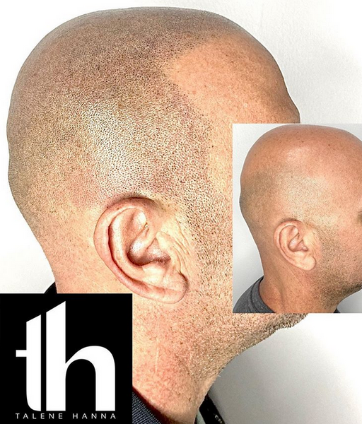 scalp micro pigmentation