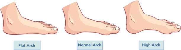 normal arch and abnormal arch