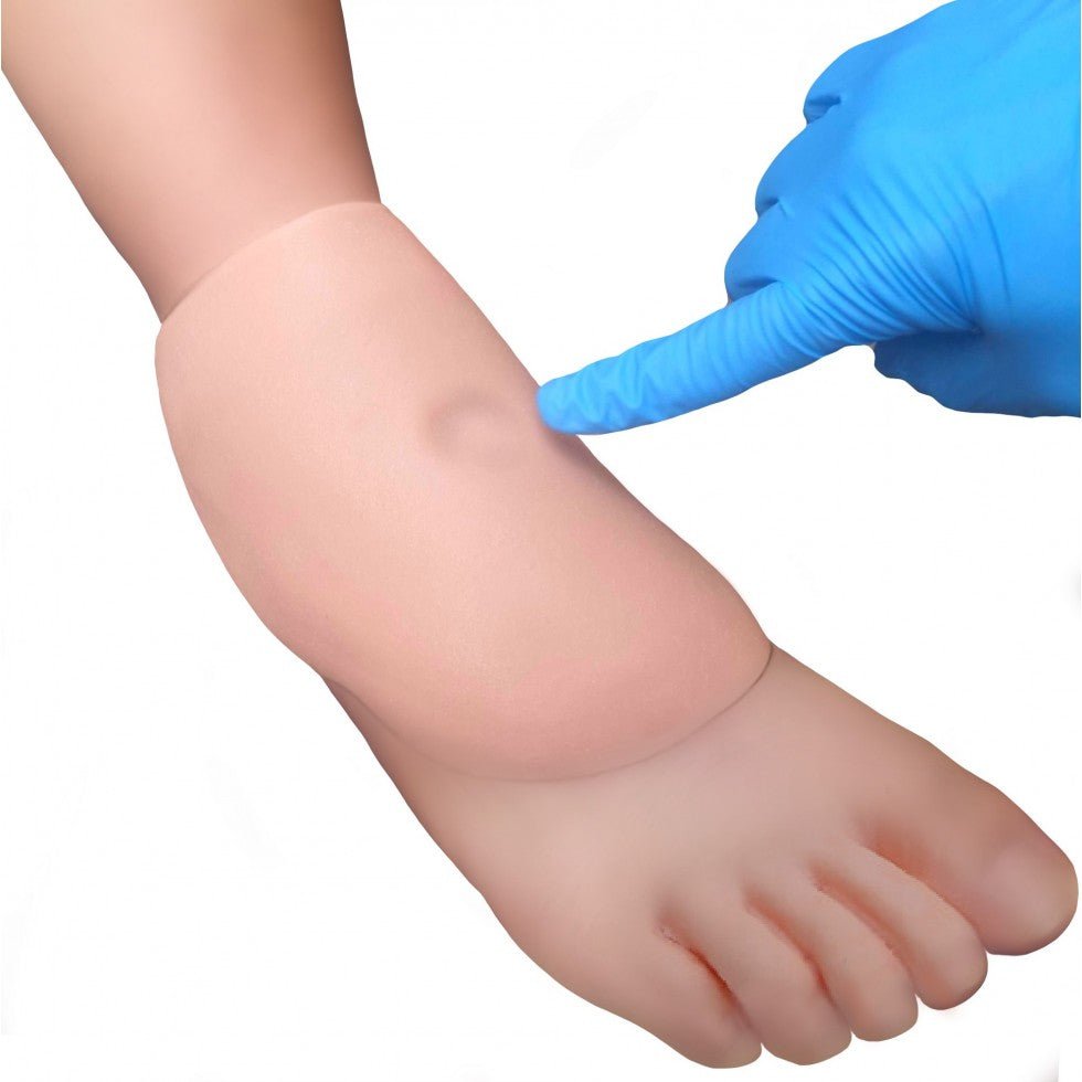 Pair Of Sticky Pitting Edema pic