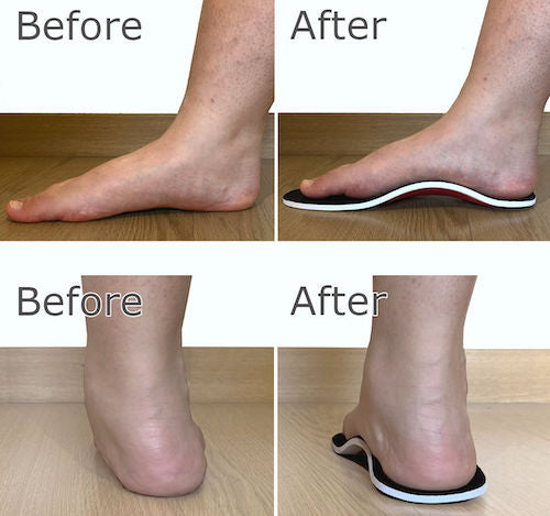 Arch Support Orthotics, Insoles for Flat Feet