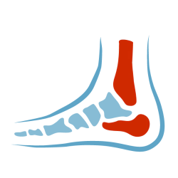 OrthoFlexx orthotics for plantar fasciitis