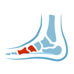 OrthoFlexx orthotics for plantar fasciitis