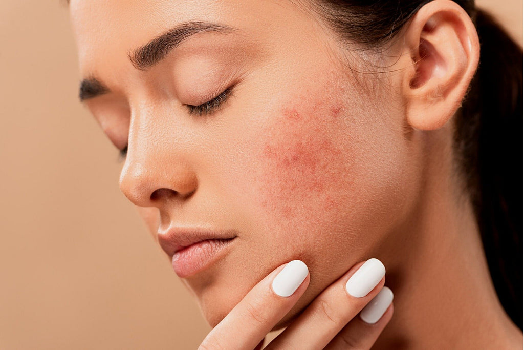 protection contre l'acné 