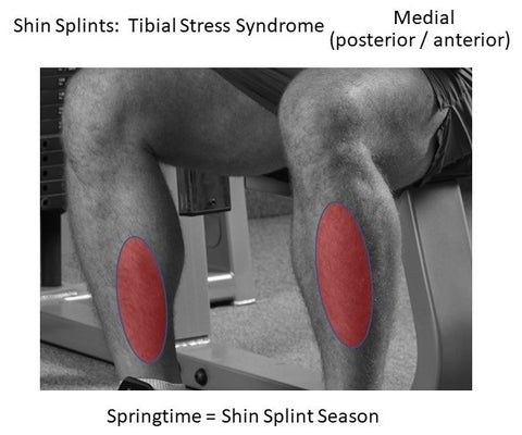 Fix Your Shin Splints (Medial Tibial Stress Syndrome) By Seth Donelson –  Stew Smith Fitness