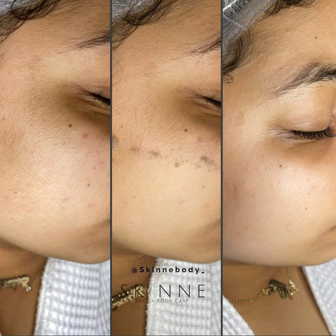 Skinne Face and Body Before and After Dermaplaning Orlando Florida