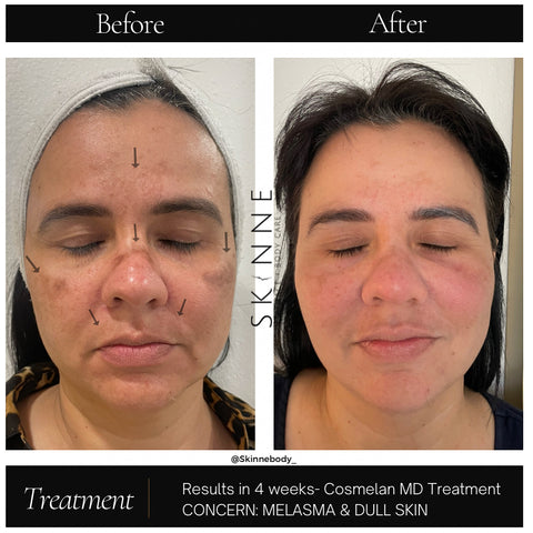 Skinne Face and Body Cosmelan Peel before and after