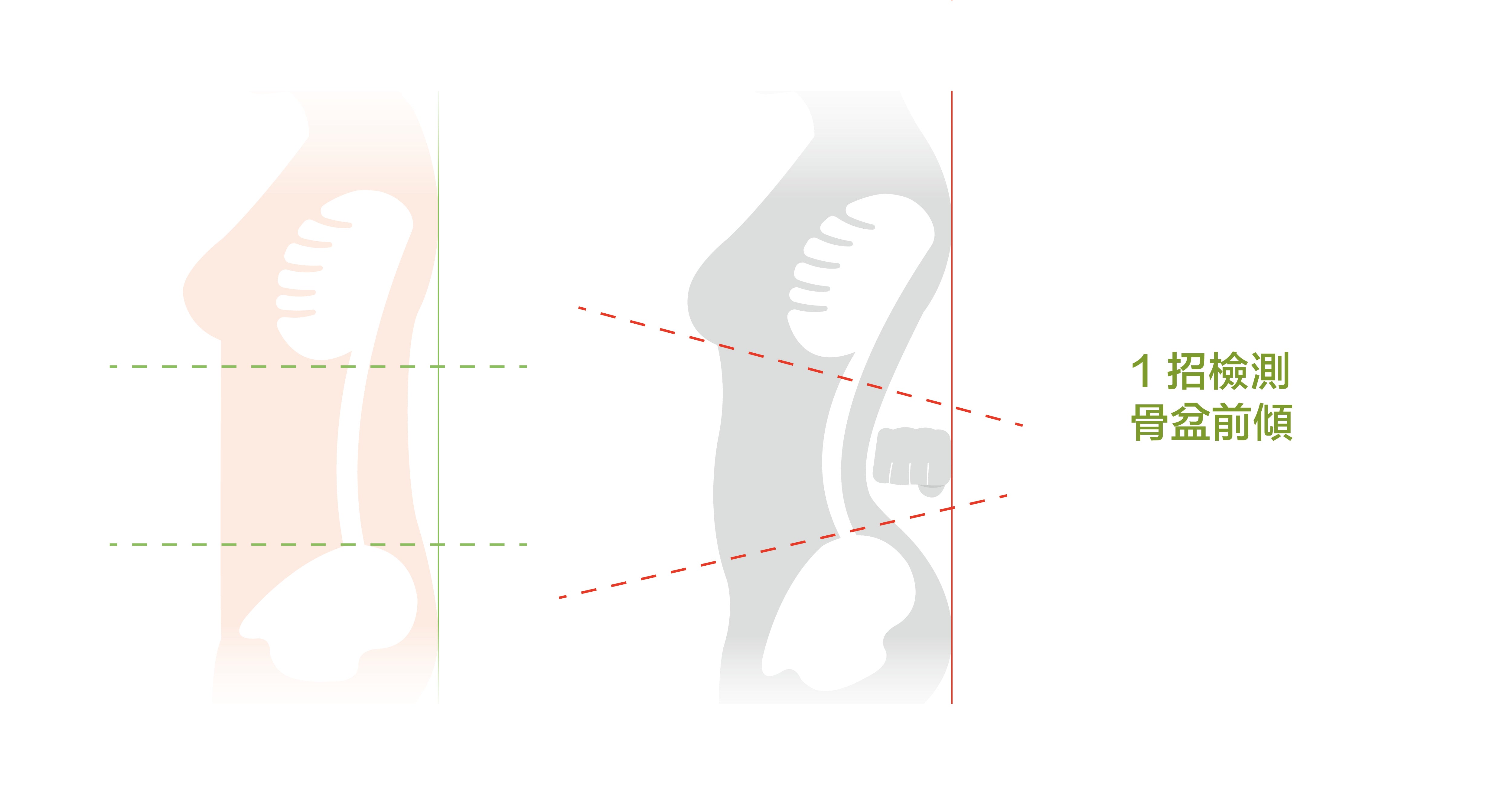 1招檢測 骨盆前傾