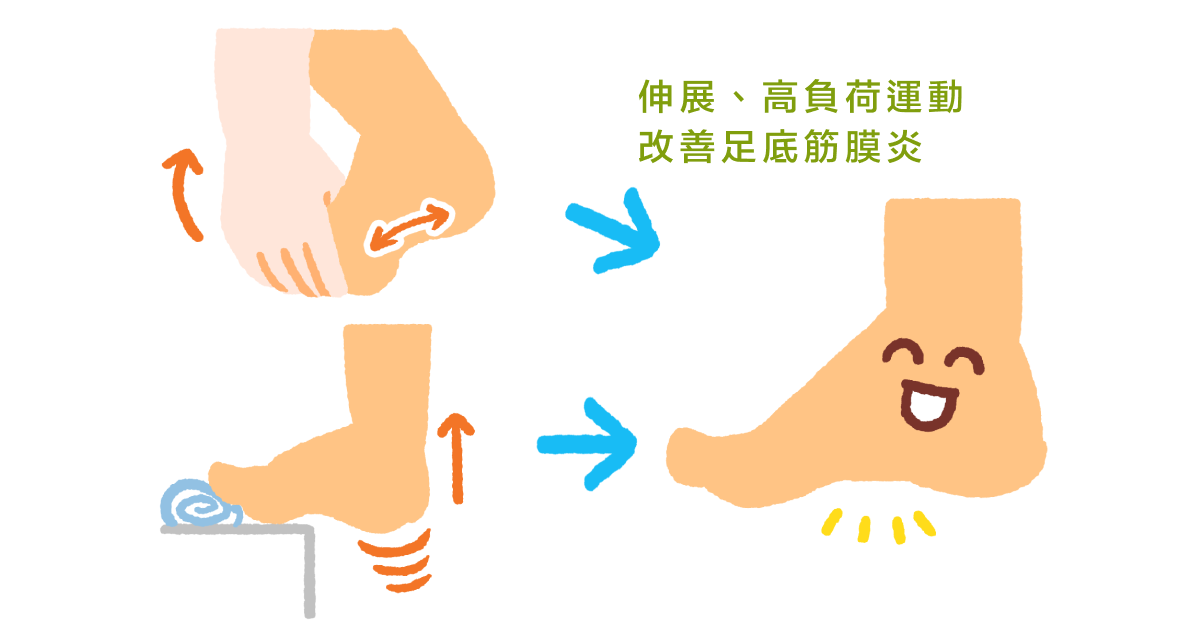 伸展、高負荷運動 改善足底筋膜炎
