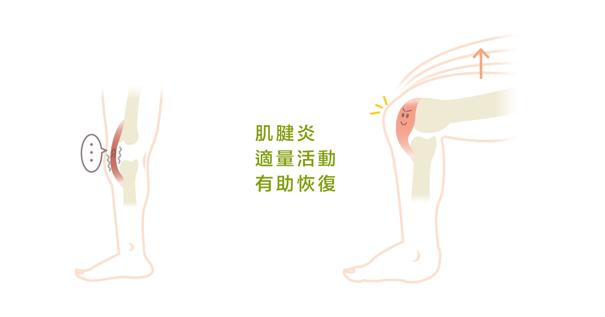 肌腱炎 適量活動 有助恢復