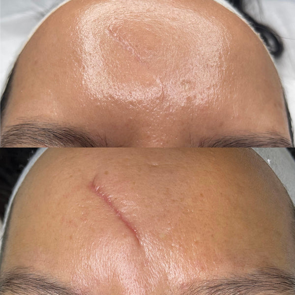 Micro-needling