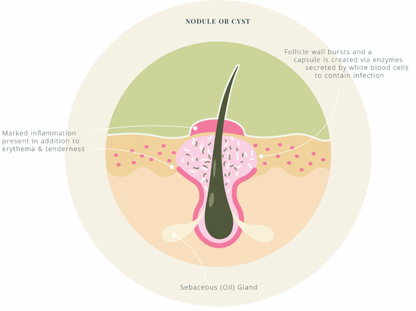 Nodule or cyst