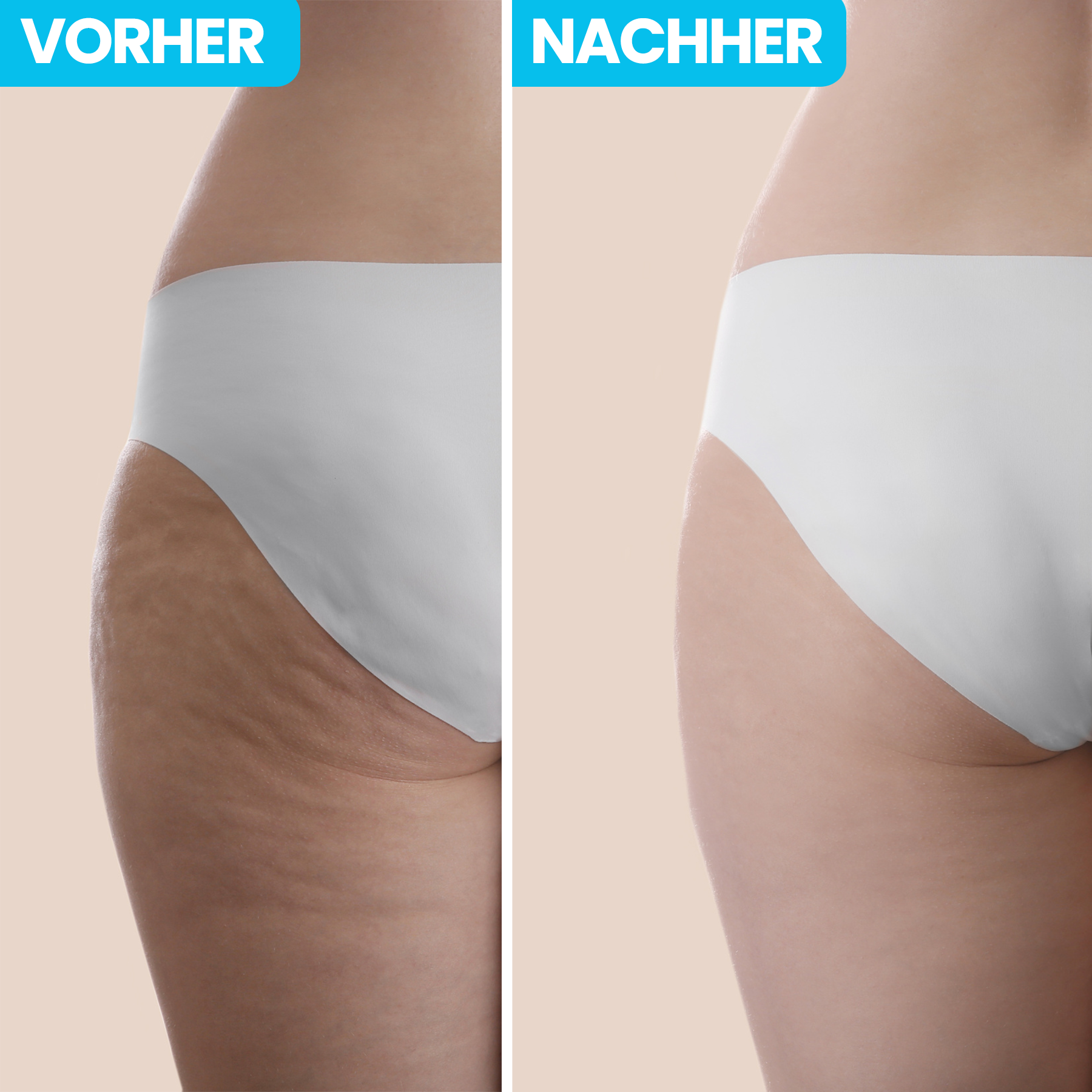 3 Tipps Um Cellulite Zu Bekämpfen Elekjack 1000