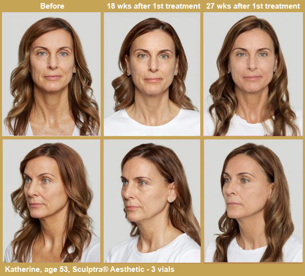 Sculptra - Katherine Before & After