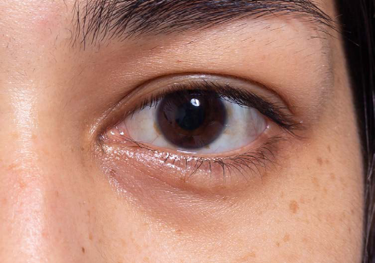 Dark Circles - Eye Conditions Calgary