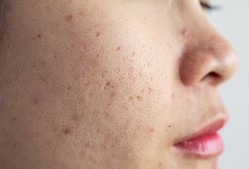 Woman's with acne scars