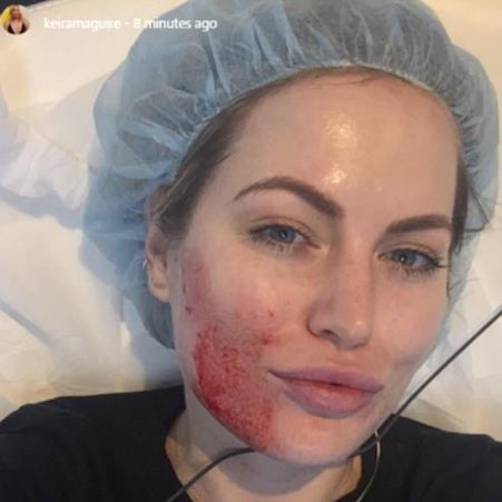 PRP Facial (Vampire Facial) Keira Maguire