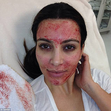 Platelet Rich Plasma Procedure on Kim Kardashian