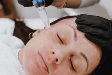 Woman having microneedling done