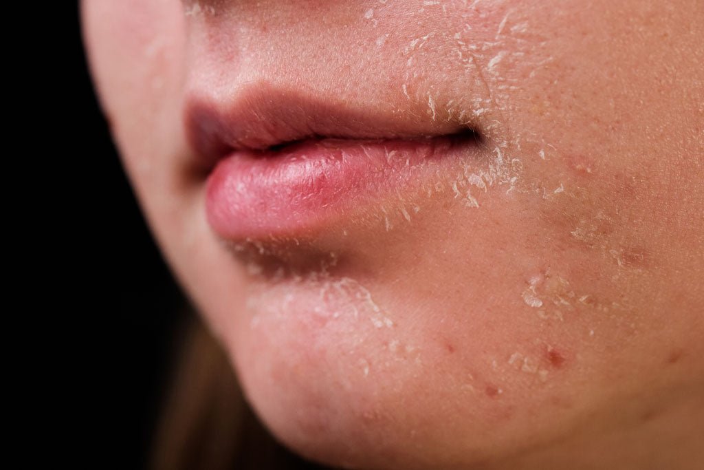The Ultimate Guide To Treating Dry Skin On The Face Causes Symptoms Skinq 