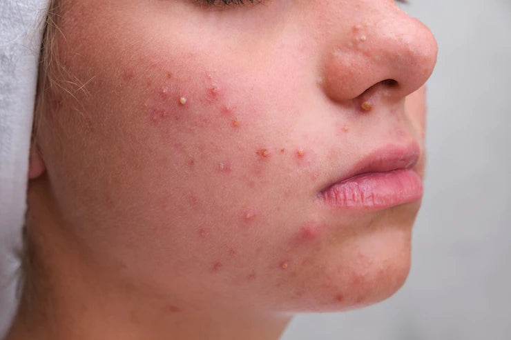 Everything You Should Know About Acne Nashé Beauty