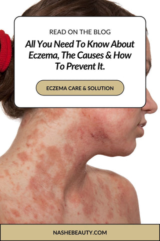 All you need to know about eczema, the causes and how to prevent it