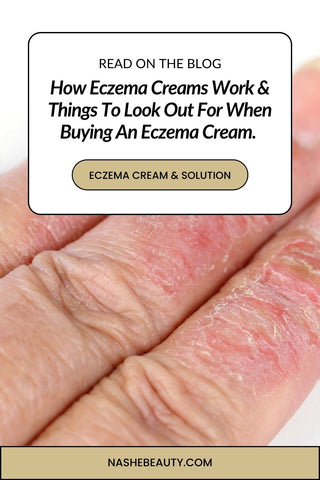 How eczema creams work and things to look out for when buying eczema cream