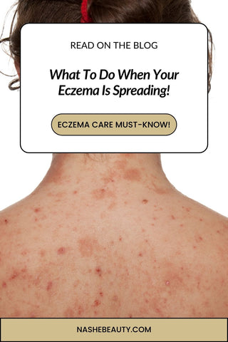 What to do when your eczema is spreading