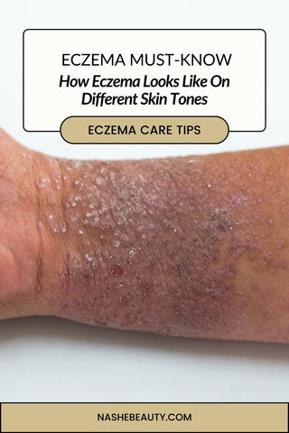 How eczema looks like on different skin tones