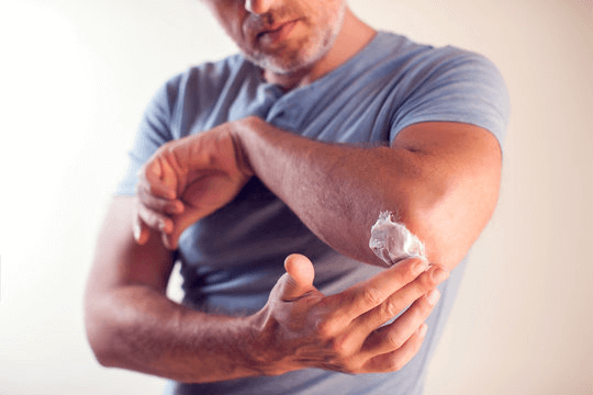 man applying cream to his elbow