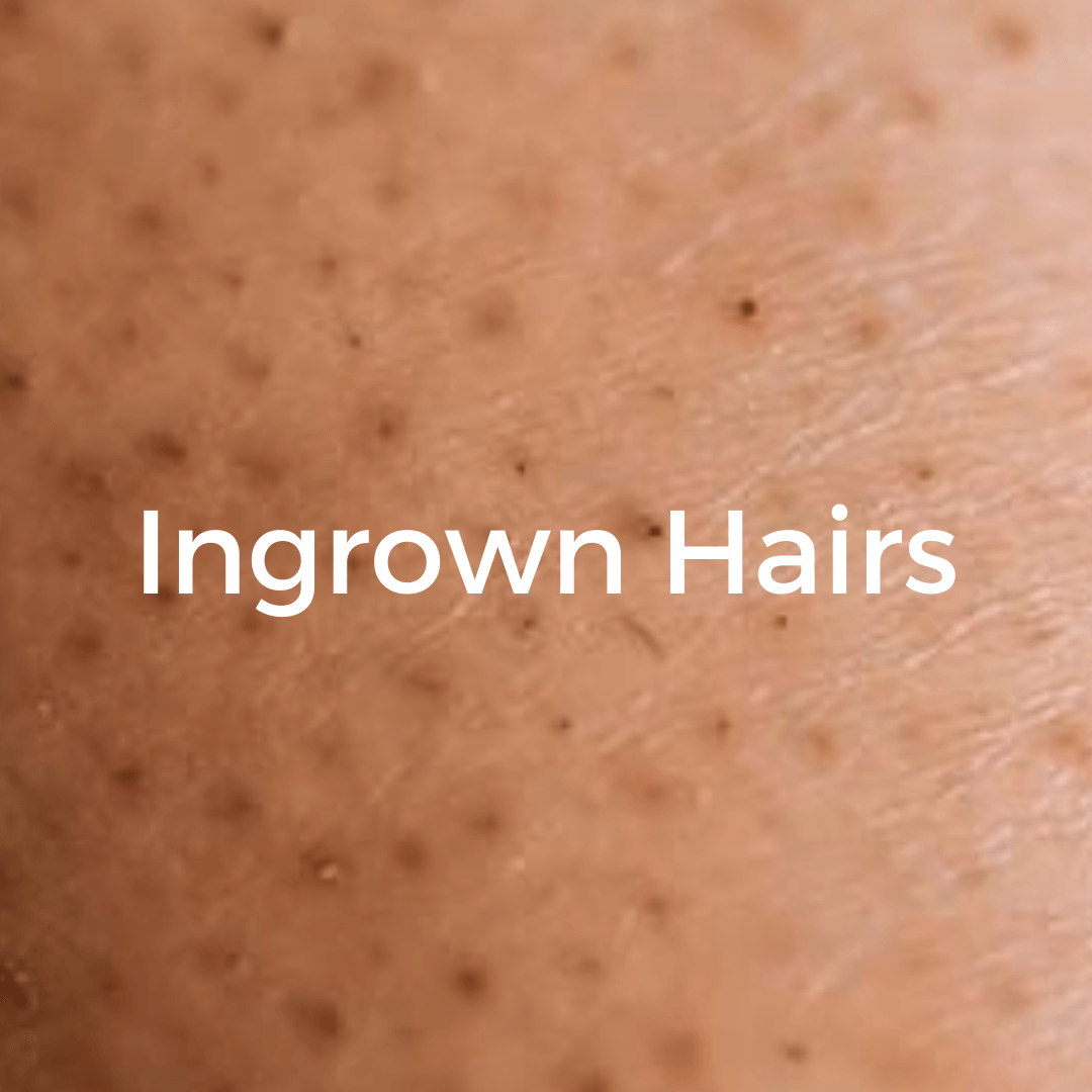 How To Get Rid Of Ingrown Hairs | Tips To Remove And Prevent Them! –  CHEEKYGLO