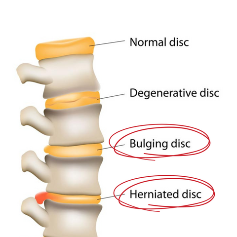 Bulging and Herniated Discs Explained 