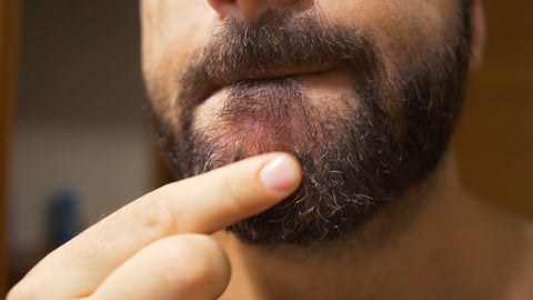 dry and brittle beard
