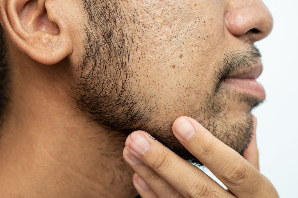 Beard Acne