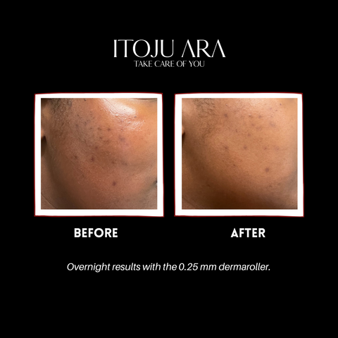 Dermaroller skin results. Before and after.