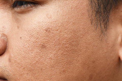 minimising pores in asian skin