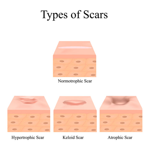 types of scars