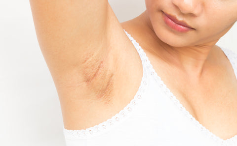 underarms pigmentation 