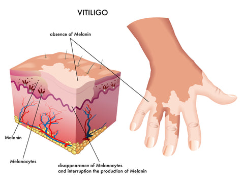 dark skin vitiligo