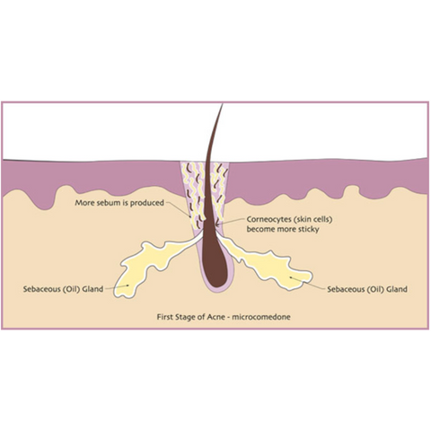 how acne is formed - how to treat acne- how to control acne in montreal 