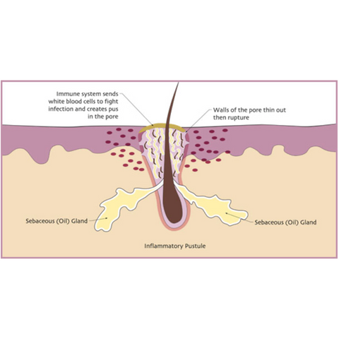 how inflamed acne happends- how acne is formed - how to control acne 