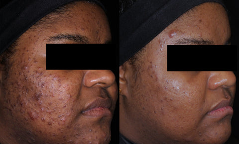 Before and after Acne treatment montreal 
