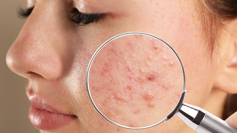 Hormonal acne How to treat it ? what are the causes 