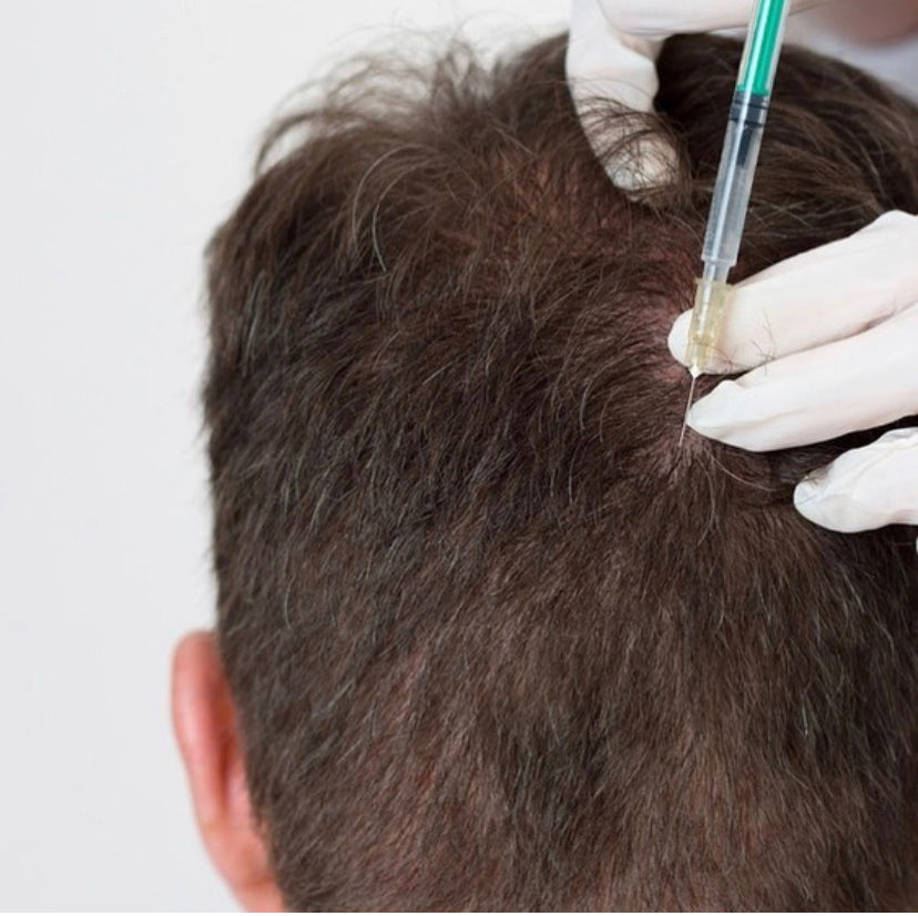 Hair loss treatment for men in montreal