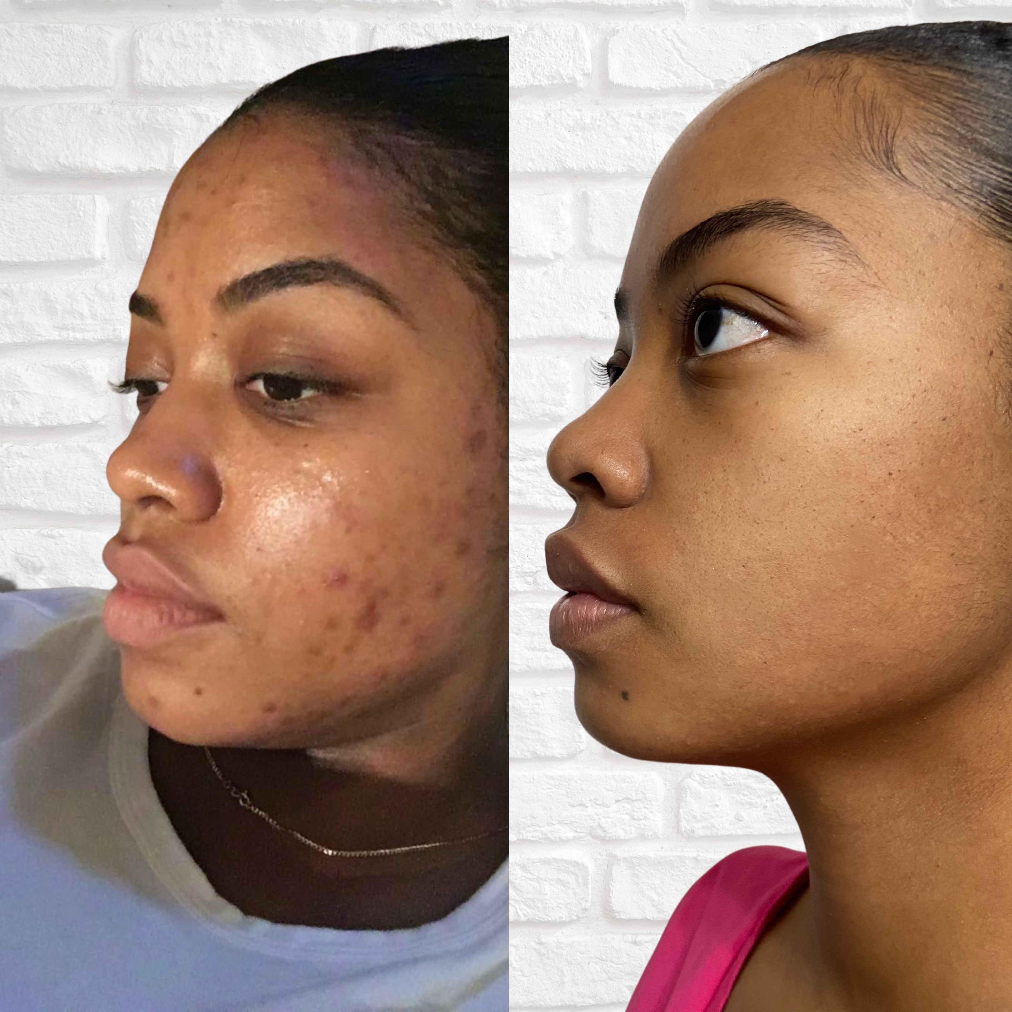 Before & After Acne Bootcamp