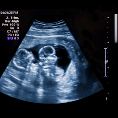 twins pre-birth as seen with an ultrasound