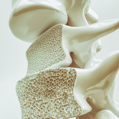 Osteoporosis, or low bone density, is part of the female athlete triad